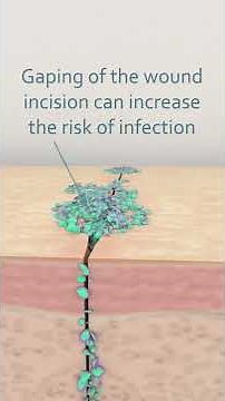 What causes wound infection?