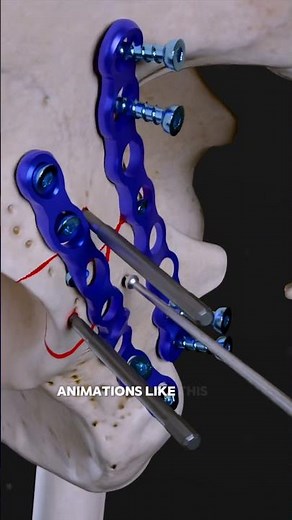 Brutal MVC Injury: Acetabular Fracture Repaired