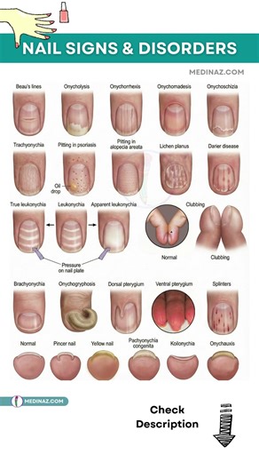 Your Nails Are Warning You! 24 Nail Signs That Reveal Hidden Diseases