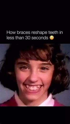 Mr Moist on Instagram: "This is actually crazy Braces work by applying gentle, continuous pressure to teeth over long periods, triggering a biological process where the bone around each tooth slowly breaks down and rebuilds, allowing the tooth to move. Timelapse videos compress months or years of this movement into seconds, showing teeth rotating, shifting forward or backward, and gradually lining up as wires and brackets guide them into position. While the motion looks fast on screen, in realit