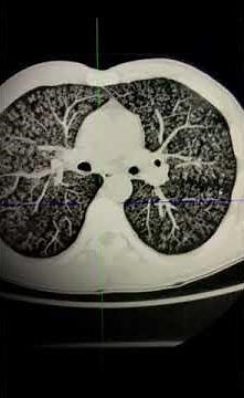 CT interpretation - centrilobular lung nodules - how to tell them apart