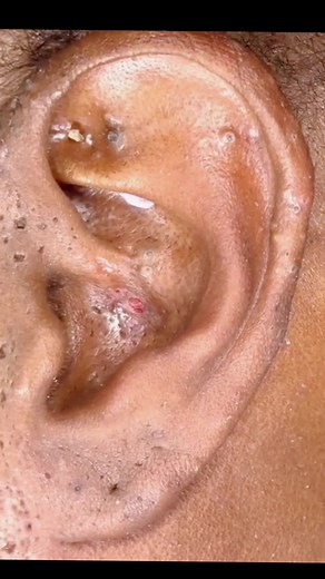 Episode 44| PART 4👂🎉 deep Black dot on ear perfect extraction #pimple #pimplepop #pimplepopper #puntosnegros