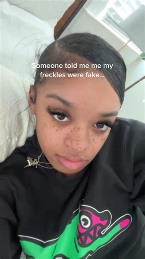 Embracing Freckles: Beauty in Diversity