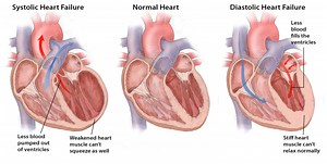Heart Failure - Cardiology Tasmania