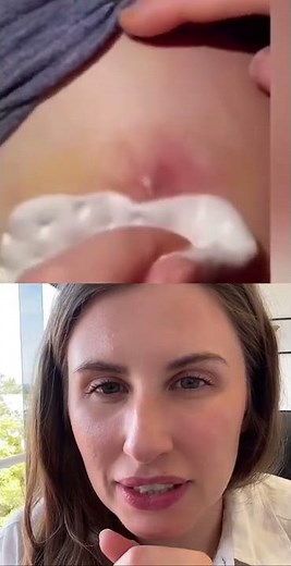 Exploding Abscess…super satisfying pop!