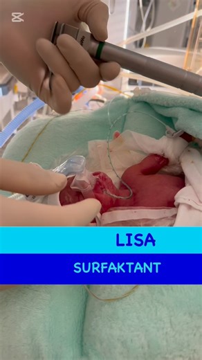 Jednotka intenzivní a resuscitační péče pro novorozence on Instagram: "LISA (SURFAKTANT) 📍 u většiny nezralých novorozenců dochází k rozvoji RDS (respiratory distress syndrome/syndrome dechové tísně novorozenců) 📍 RDS souvisí s nedostatkem surfaktantu v nezralých plicích 📍 terapie RDS: ventilační podpora a oxygenoterapie + aplikace exogenního surfaktantu v indikovaných případech LISA 🫁 = less invasive surfactant administration (méně invazivní podání surfaktantu/aplikace surfaktantu tenkým ka