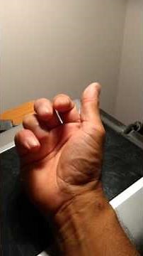 Simple rehabilitation for mallet finger after partial removal of splint