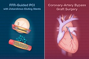 5.2K views · 141 reactions | Quick Take: FFR-Guided PCI vs. Coronary Bypass Surgery https://nej.md/3qmjHFJ | The New England Journal of Medicine | Facebook