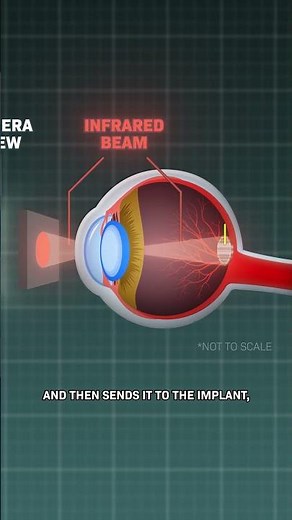 New Eye Implant Might Save Your Eyesight