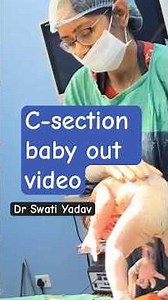 C-Section Baby Birth 👶 | Real, Emotional First Moments | Cesarean Delivery|#csectionbirth #short