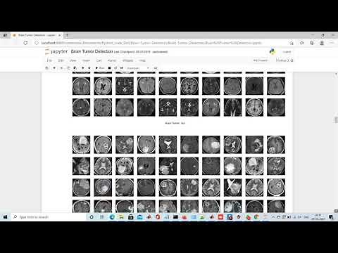 BRAIN TUMOR DETECTION AND SEGMENTATION | PYTHON CODE www.matlabprojectscode.com