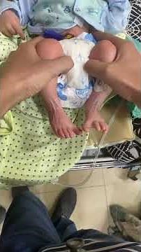 Barlow and ortolani maneuvers for developmental dysplasia of hip joint in a neonate.