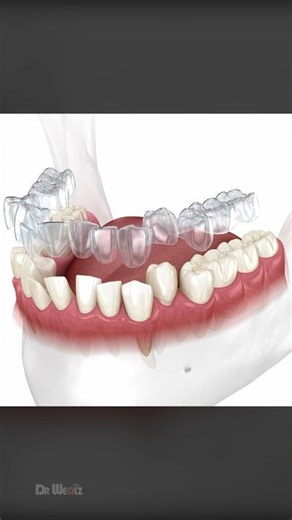 How Does Invisalign Aligners Work To Straighten Teeth