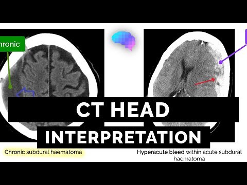 CT Head Interpretation for Beginners - OSCE Guide | UKMLA | CPSA | PLAB 2