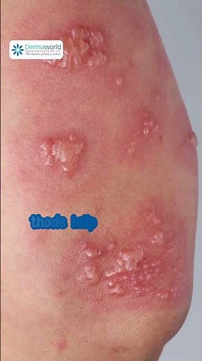 What is Herpes? | Skin viral infection | Herpes simplex virus (HSV) | #dermatologist