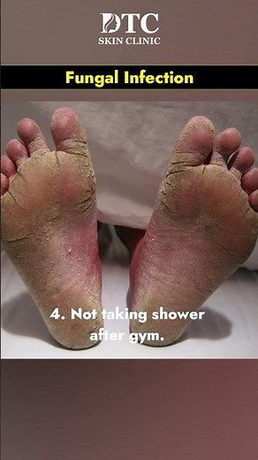 What is Fungal Infection & Its Treatment | DTC Skin Clinic
